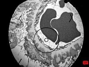 M,63y. | membranous glomerulopathy - digital photo from the screen M,63y. | membranous glomerulopathy - digital photo from the screen